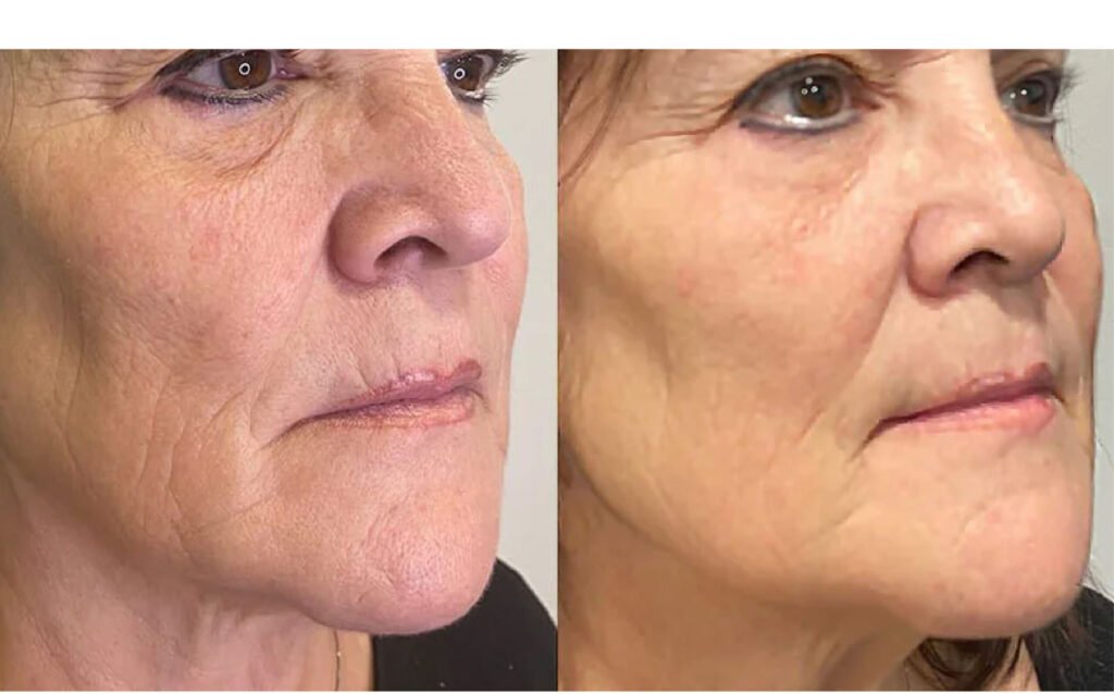 Garis halus di wajah bisa menjadi salah satu tanda penuaan yang paling mengganggu.